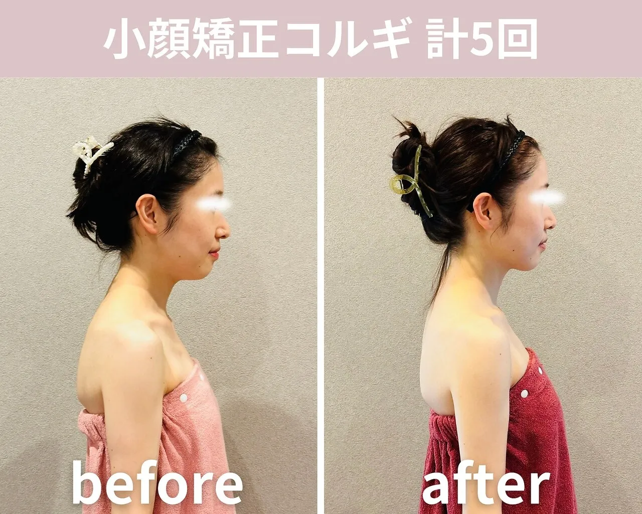 【小顔矯正コルギ】計5回の結果