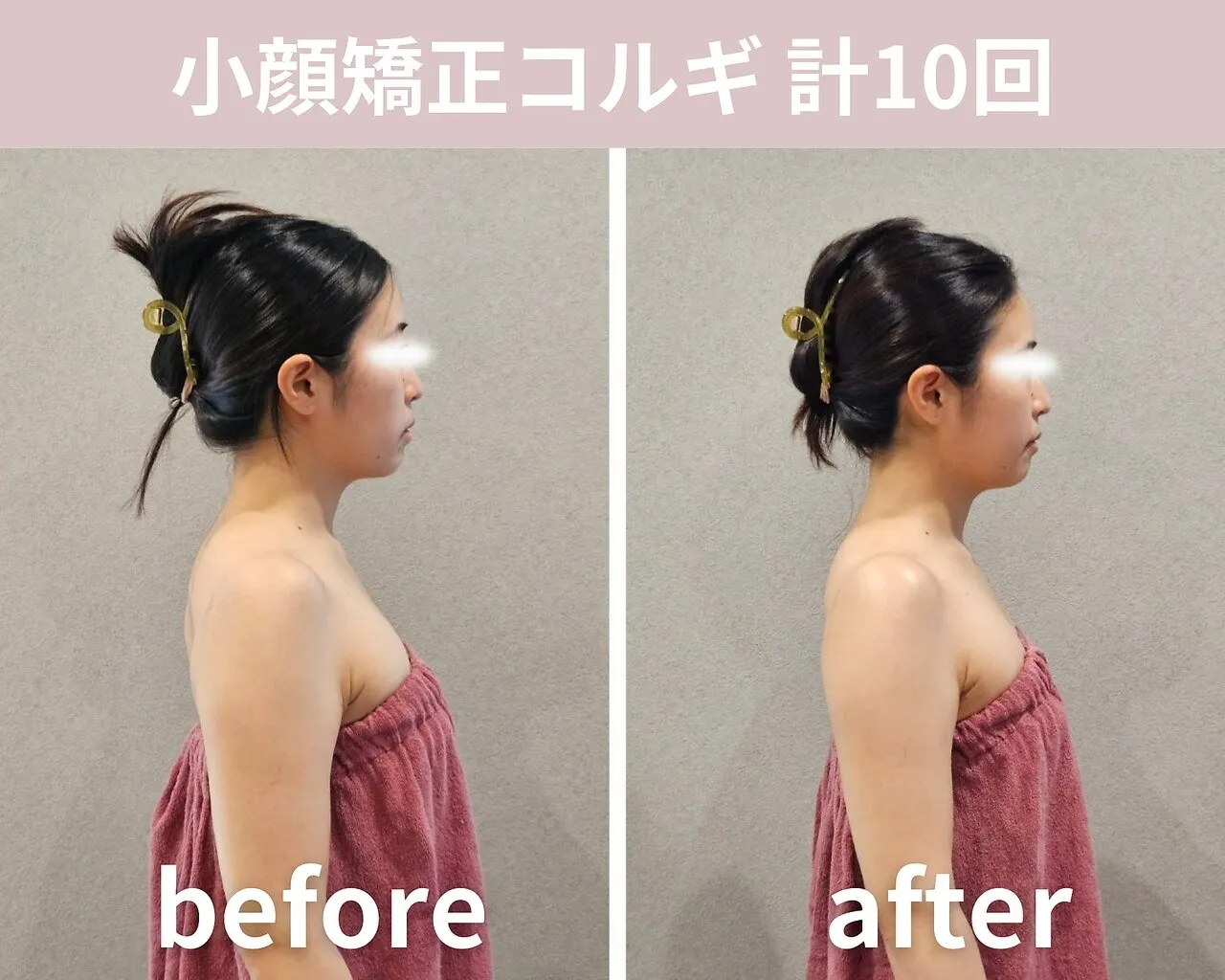 【小顔矯正コルギ】計10回の結果